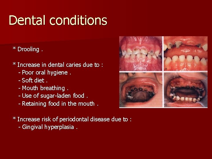 Dental conditions * Drooling. * Increase in dental caries due to : - Poor