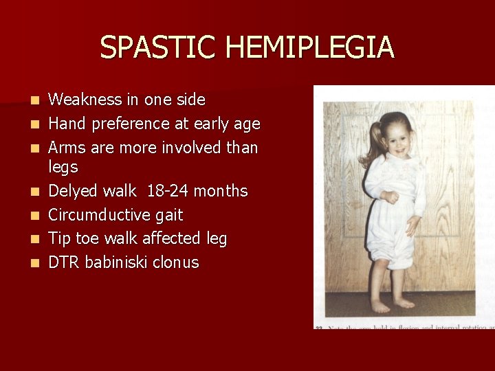 SPASTIC HEMIPLEGIA n n n n Weakness in one side Hand preference at early