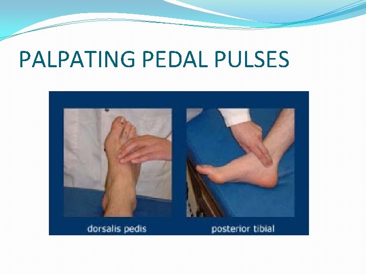 PALPATING PEDAL PULSES 