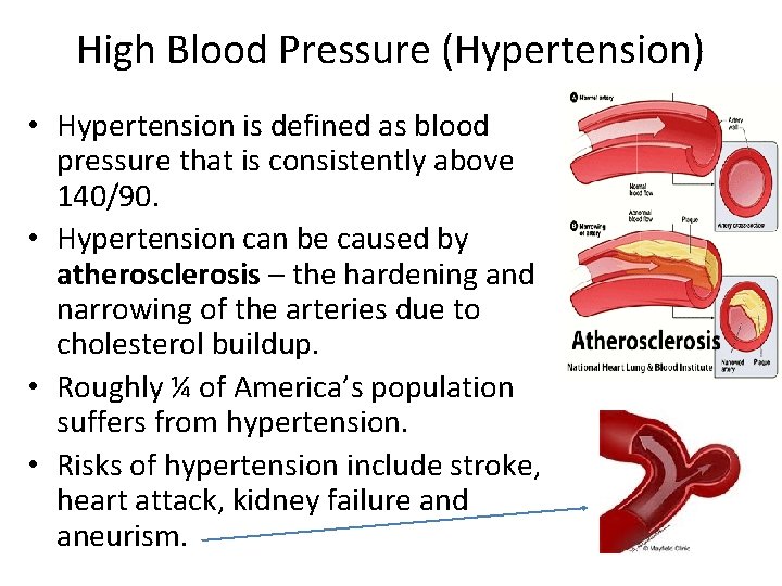 High Blood Pressure (Hypertension) • Hypertension is defined as blood pressure that is consistently