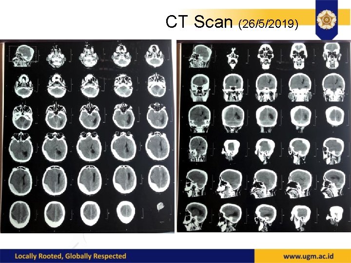 CT Scan (26/5/2019) 