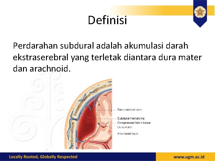 Definisi Perdarahan subdural adalah akumulasi darah ekstraserebral yang terletak diantara dura mater dan arachnoid.