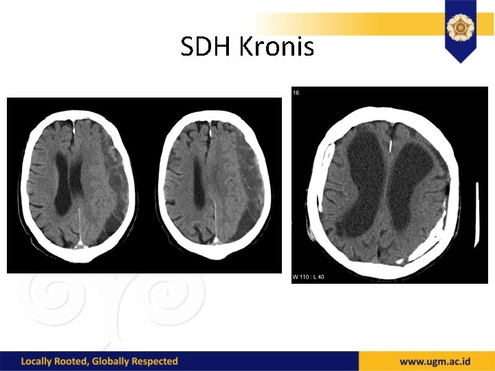 SDH Kronis 