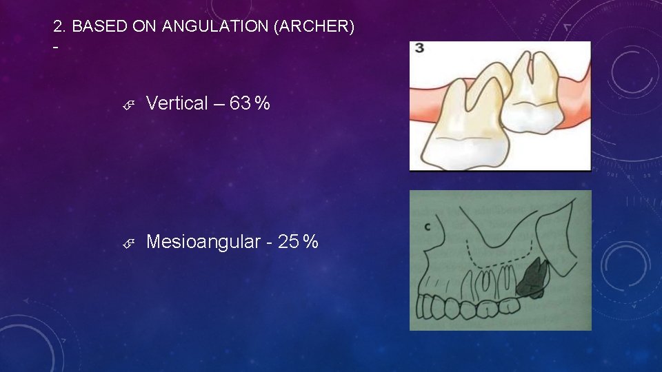 2. BASED ON ANGULATION (ARCHER) - Vertical – 63 % Mesioangular - 25 %