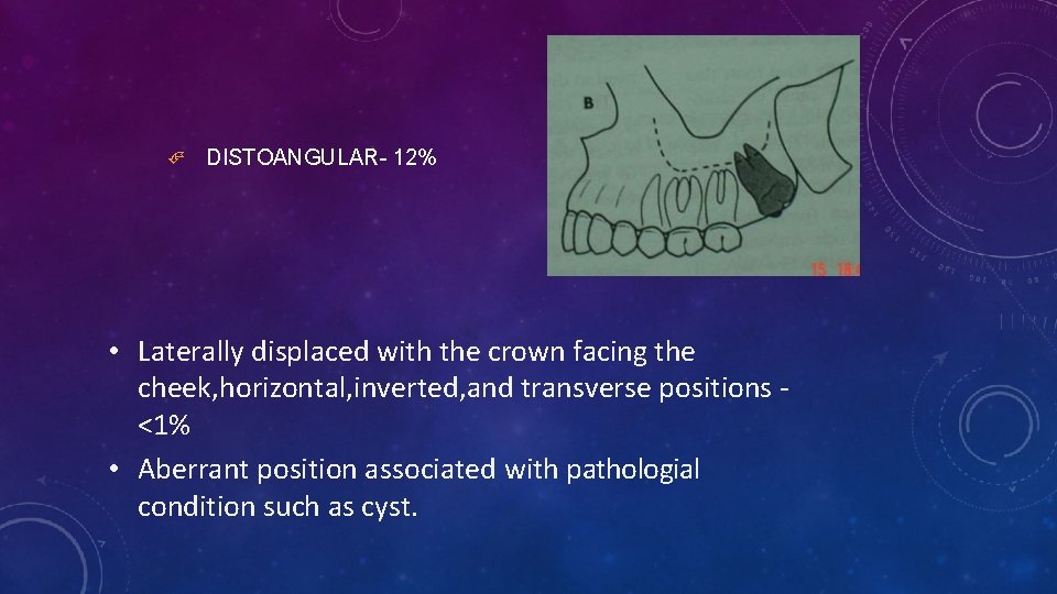 DISTOANGULAR- 12% • Laterally displaced with the crown facing the cheek, horizontal, inverted,