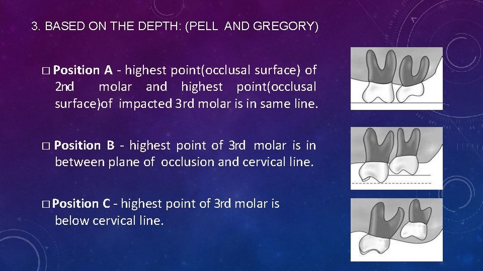 3. BASED ON THE DEPTH: (PELL AND GREGORY) � Position A - highest point(occlusal