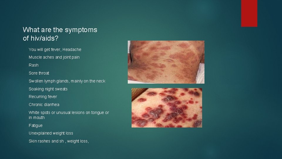 What are the symptoms of hiv/aids? You will get fever, Headache Muscle aches and