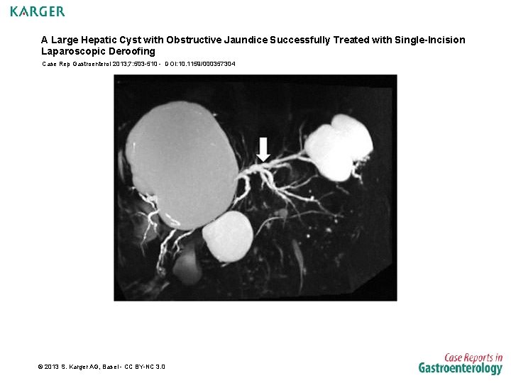 A Large Hepatic Cyst with Obstructive Jaundice Successfully Treated with Single-Incision Laparoscopic Deroofing Case