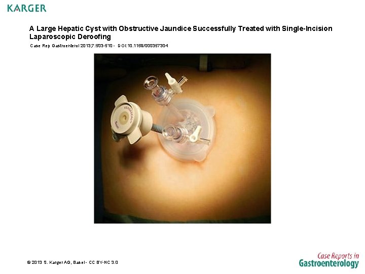 A Large Hepatic Cyst with Obstructive Jaundice Successfully Treated with Single-Incision Laparoscopic Deroofing Case
