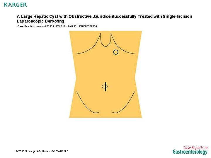 A Large Hepatic Cyst with Obstructive Jaundice Successfully Treated with Single-Incision Laparoscopic Deroofing Case