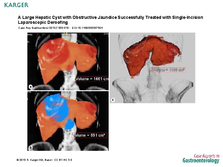 A Large Hepatic Cyst with Obstructive Jaundice Successfully Treated with Single-Incision Laparoscopic Deroofing Case