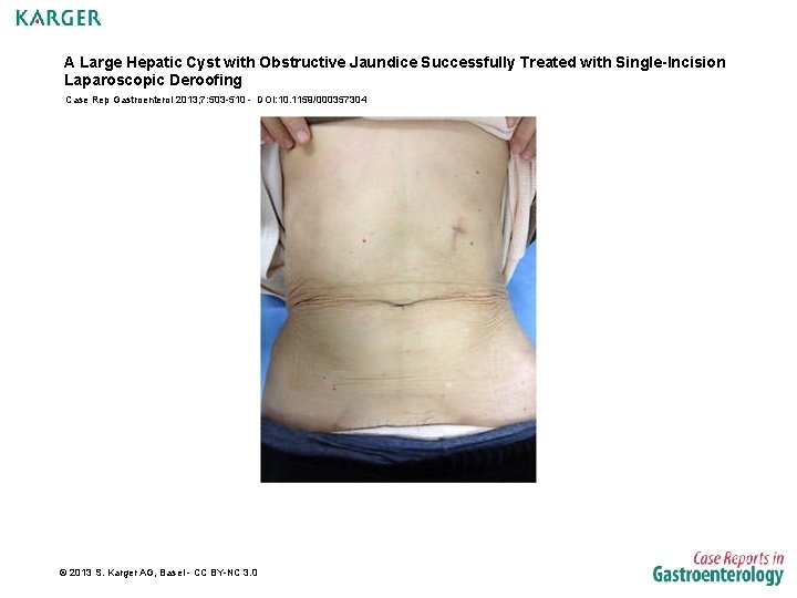 A Large Hepatic Cyst with Obstructive Jaundice Successfully Treated with Single-Incision Laparoscopic Deroofing Case
