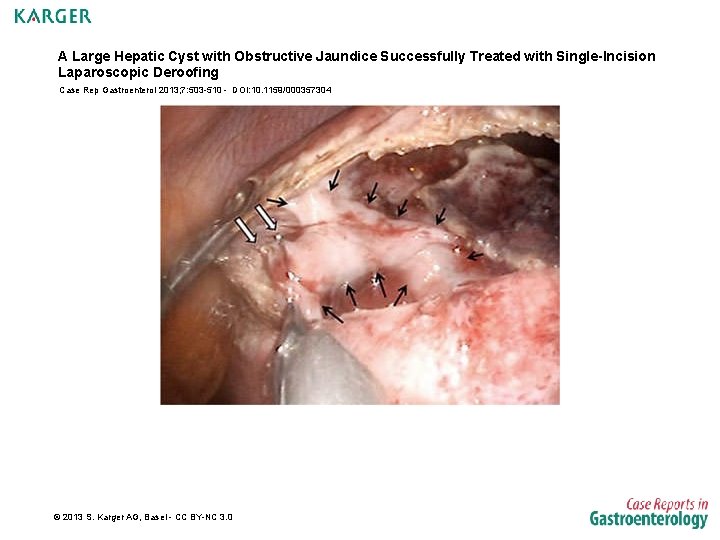 A Large Hepatic Cyst with Obstructive Jaundice Successfully Treated with Single-Incision Laparoscopic Deroofing Case
