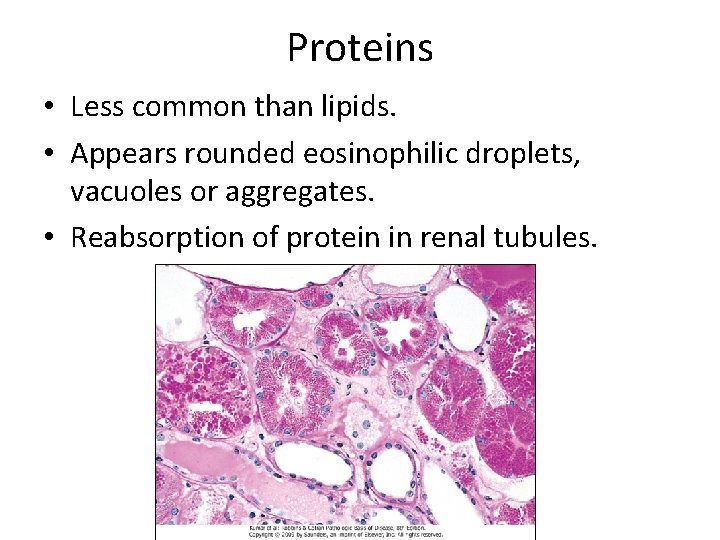 Proteins • Less common than lipids. • Appears rounded eosinophilic droplets, vacuoles or aggregates.