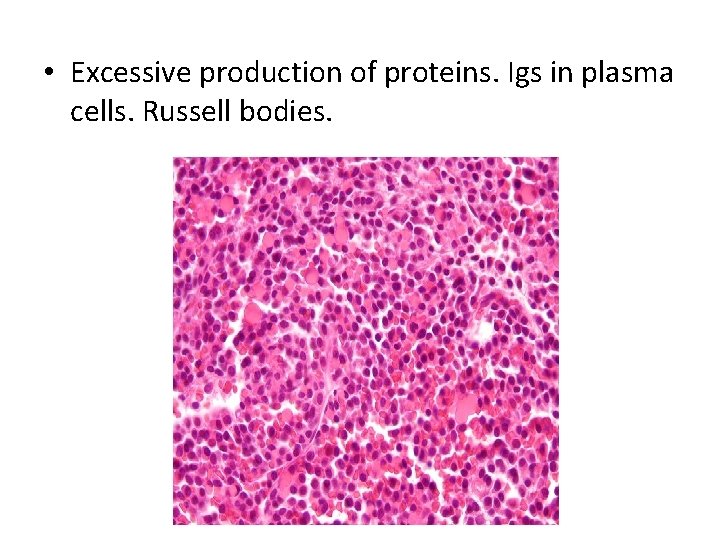  • Excessive production of proteins. Igs in plasma cells. Russell bodies. 
