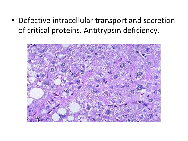  • Defective intracellular transport and secretion of critical proteins. Antitrypsin deficiency. 