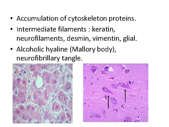  • Accumulation of cytoskeleton proteins. • Intermediate filaments : keratin, neurofilaments, desmin, vimentin,