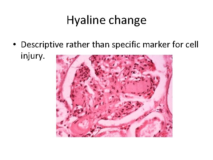 Hyaline change • Descriptive rather than specific marker for cell injury. 