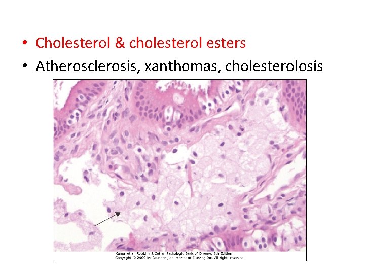  • Cholesterol & cholesterol esters • Atherosclerosis, xanthomas, cholesterolosis 