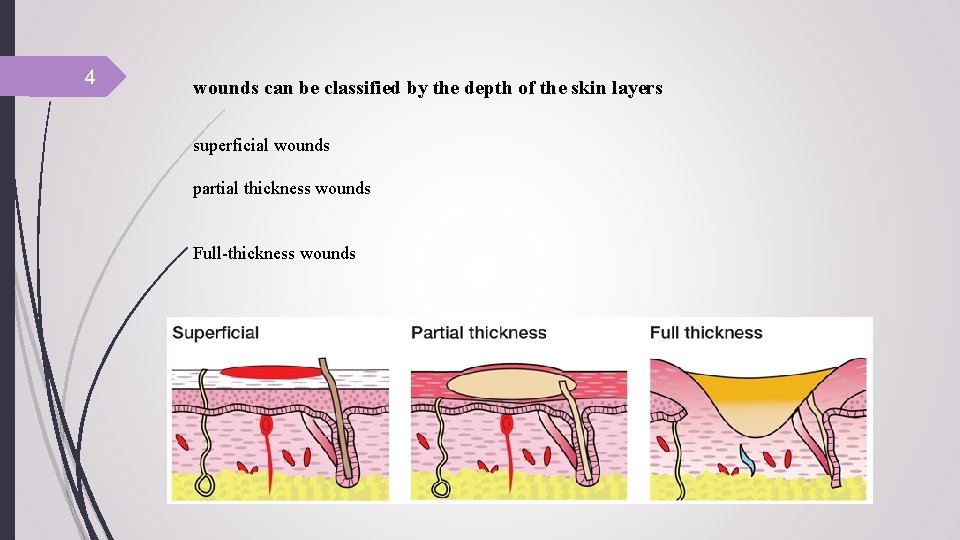 4 wounds can be classified by the depth of the skin layers superficial wounds