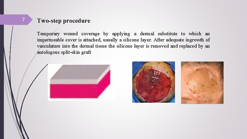 7 Two-step procedure Temporary wound coverage by applying a dermal substitute to which an