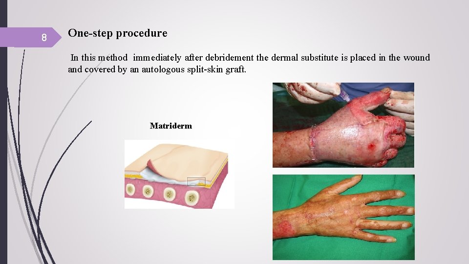 8 One-step procedure In this method immediately after debridement the dermal substitute is placed