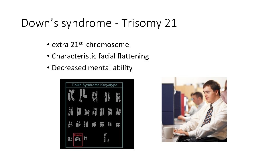 Down’s syndrome - Trisomy 21 • extra 21 st chromosome • Characteristic facial flattening Down’s syndrome - Trisomy 21 • extra 21 st chromosome • Characteristic facial flattening