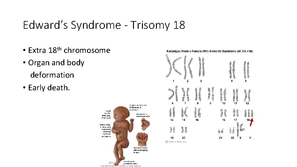 Edward’s Syndrome - Trisomy 18 • Extra 18 th chromosome • Organ and body Edward’s Syndrome - Trisomy 18 • Extra 18 th chromosome • Organ and body