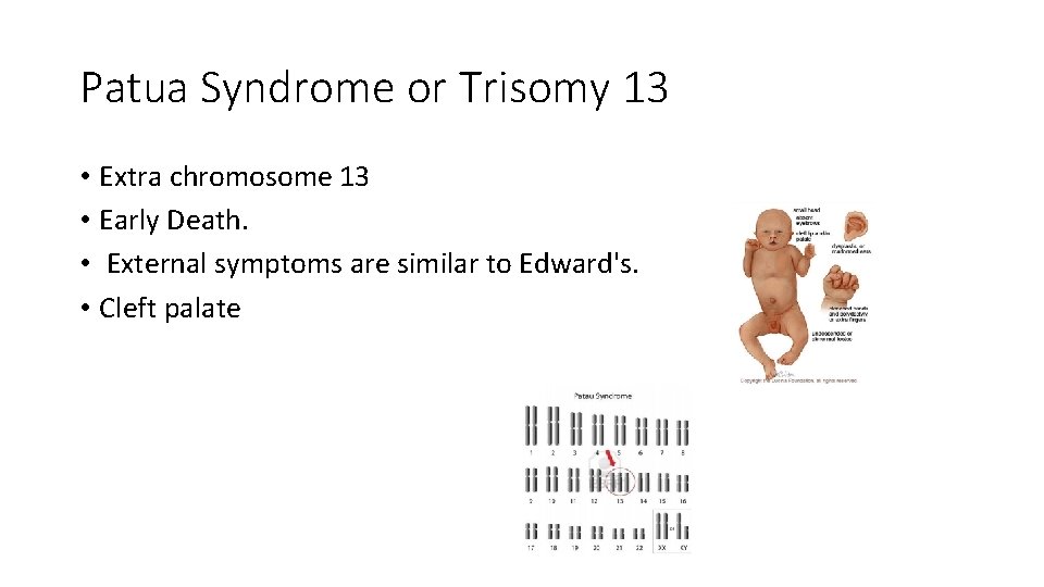 Patua Syndrome or Trisomy 13 • Extra chromosome 13 • Early Death. • External Patua Syndrome or Trisomy 13 • Extra chromosome 13 • Early Death. • External