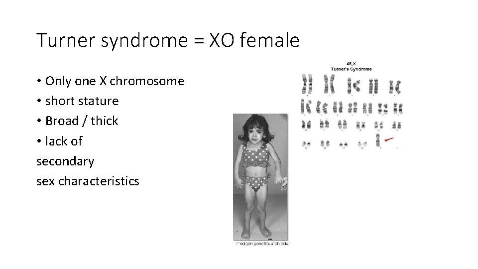 Turner syndrome = XO female • Only one X chromosome • short stature • Turner syndrome = XO female • Only one X chromosome • short stature •