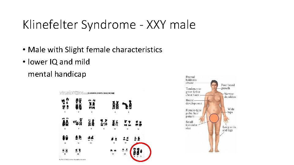 Klinefelter Syndrome - XXY male • Male with Slight female characteristics • lower IQ Klinefelter Syndrome - XXY male • Male with Slight female characteristics • lower IQ