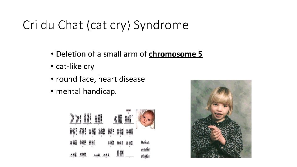 Cri du Chat (cat cry) Syndrome • Deletion of a small arm of chromosome Cri du Chat (cat cry) Syndrome • Deletion of a small arm of chromosome