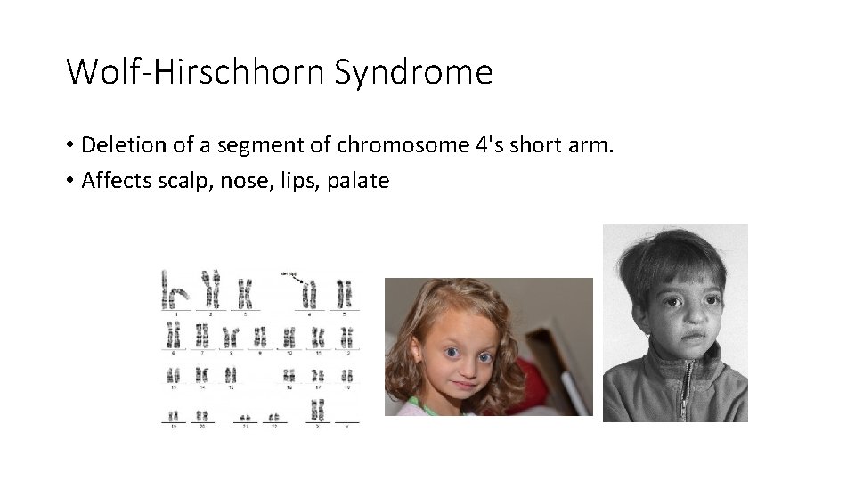 Wolf-Hirschhorn Syndrome • Deletion of a segment of chromosome 4's short arm. • Affects Wolf-Hirschhorn Syndrome • Deletion of a segment of chromosome 4's short arm. • Affects