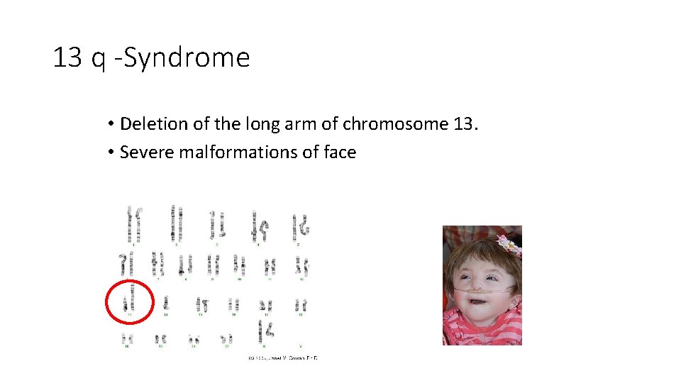 13 q -Syndrome • Deletion of the long arm of chromosome 13. • Severe 13 q -Syndrome • Deletion of the long arm of chromosome 13. • Severe