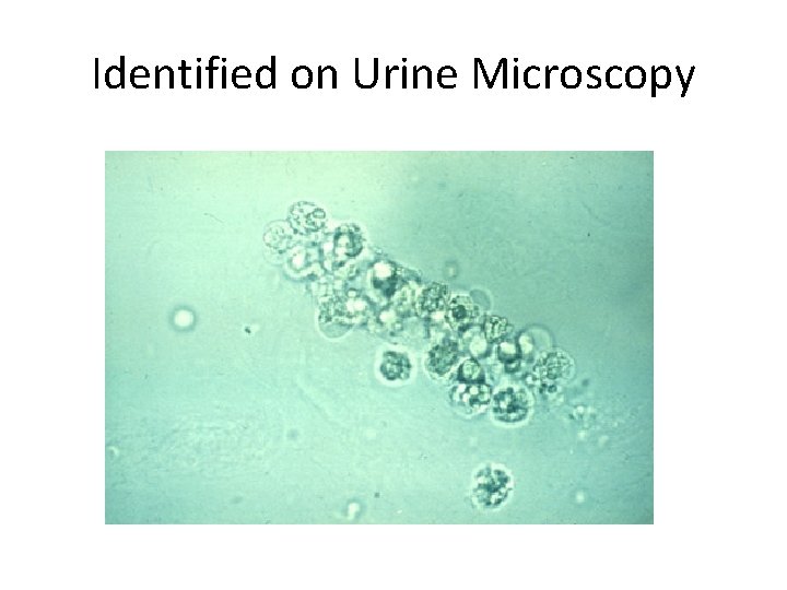 Identified on Urine Microscopy 