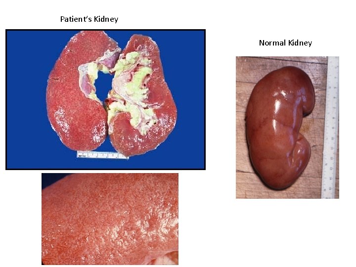 Patient’s Kidney Normal Kidney 