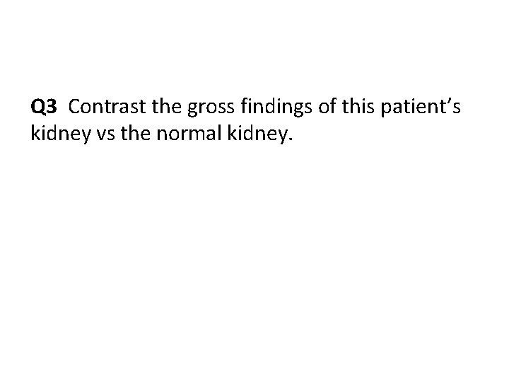 Q 3 Contrast the gross findings of this patient’s kidney vs the normal kidney.