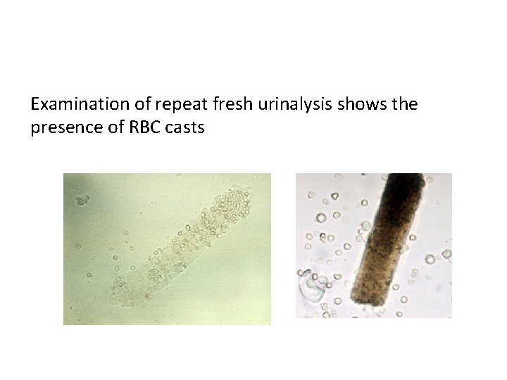 Examination of repeat fresh urinalysis shows the presence of RBC casts 
