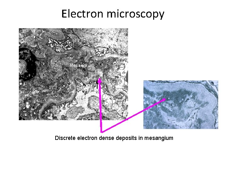 Electron microscopy Discrete electron dense deposits in mesangium 