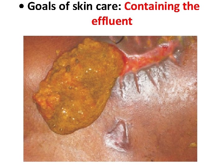  • Goals of skin care: Containing the effluent 