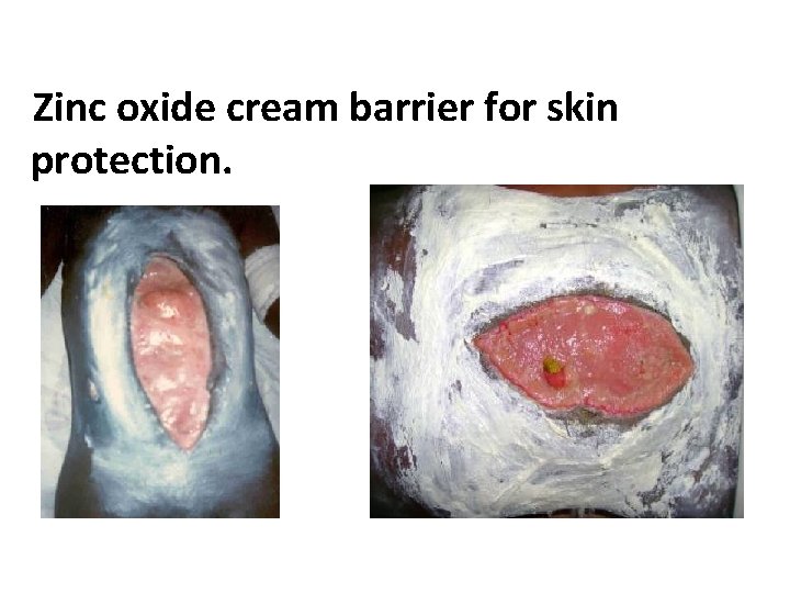 Zinc oxide cream barrier for skin protection. 
