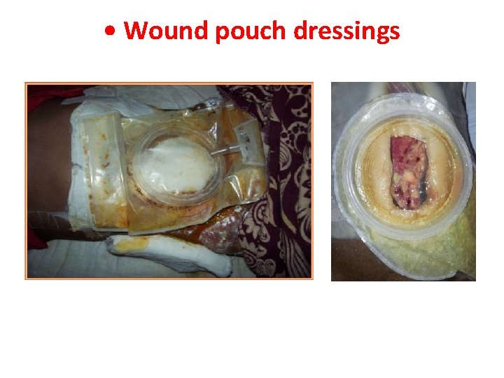  • Wound pouch dressings 