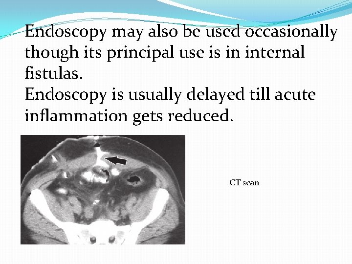 Endoscopy may also be used occasionally though its principal use is in internal fistulas.
