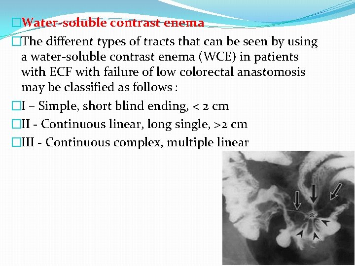 �Water-soluble contrast enema �The different types of tracts that can be seen by using