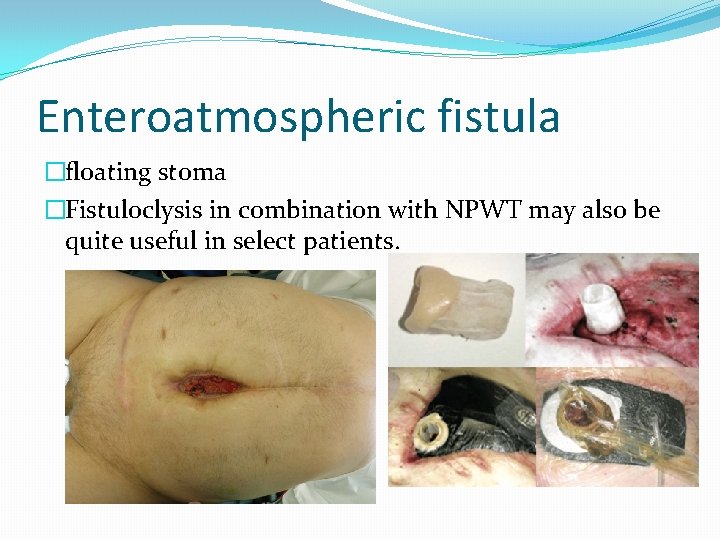 Enteroatmospheric fistula �floating stoma �Fistuloclysis in combination with NPWT may also be quite useful