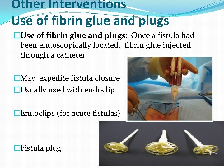 Other Interventions Use of fibrin glue and plugs �Use of fibrin glue and plugs: