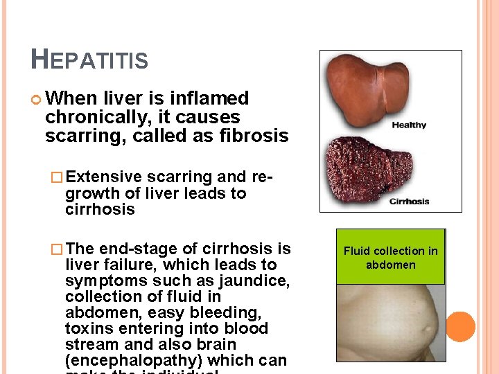 HEPATITIS When liver is inflamed chronically, it causes scarring, called as fibrosis � Extensive
