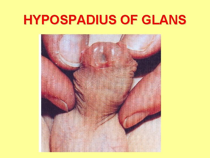 HYPOSPADIUS OF GLANS 