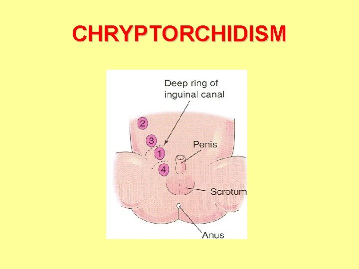 CHRYPTORCHIDISM 