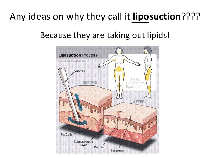 Any ideas on why they call it _____ liposuction? ? Because they are taking
